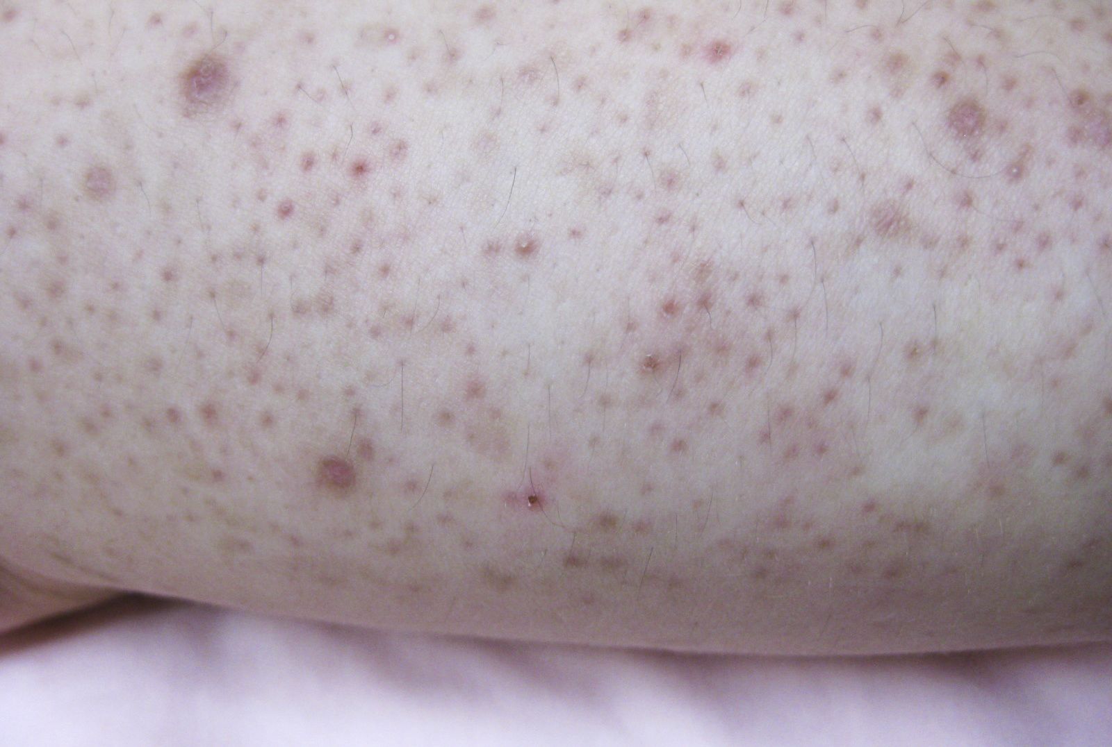 10 Facts About Keratosis Pilaris From Dr Pimple Popper Mental Floss