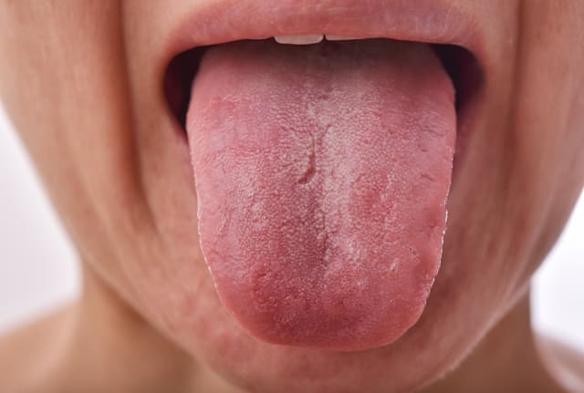 Cracks on your tongue can be a peculiar sight.