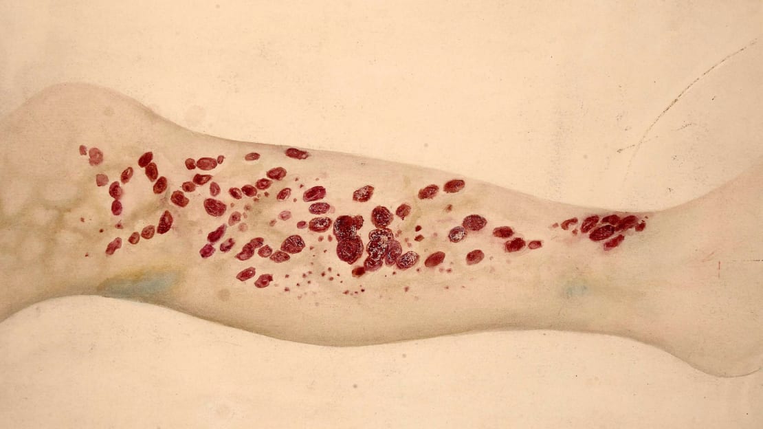 Watercolor drawing of the leg of a patient, age 50, who had scurvy for 12 months' standing.