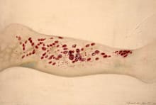 Watercolor drawing of the leg of a patient, age 50, who had scurvy for 12 months' standing.