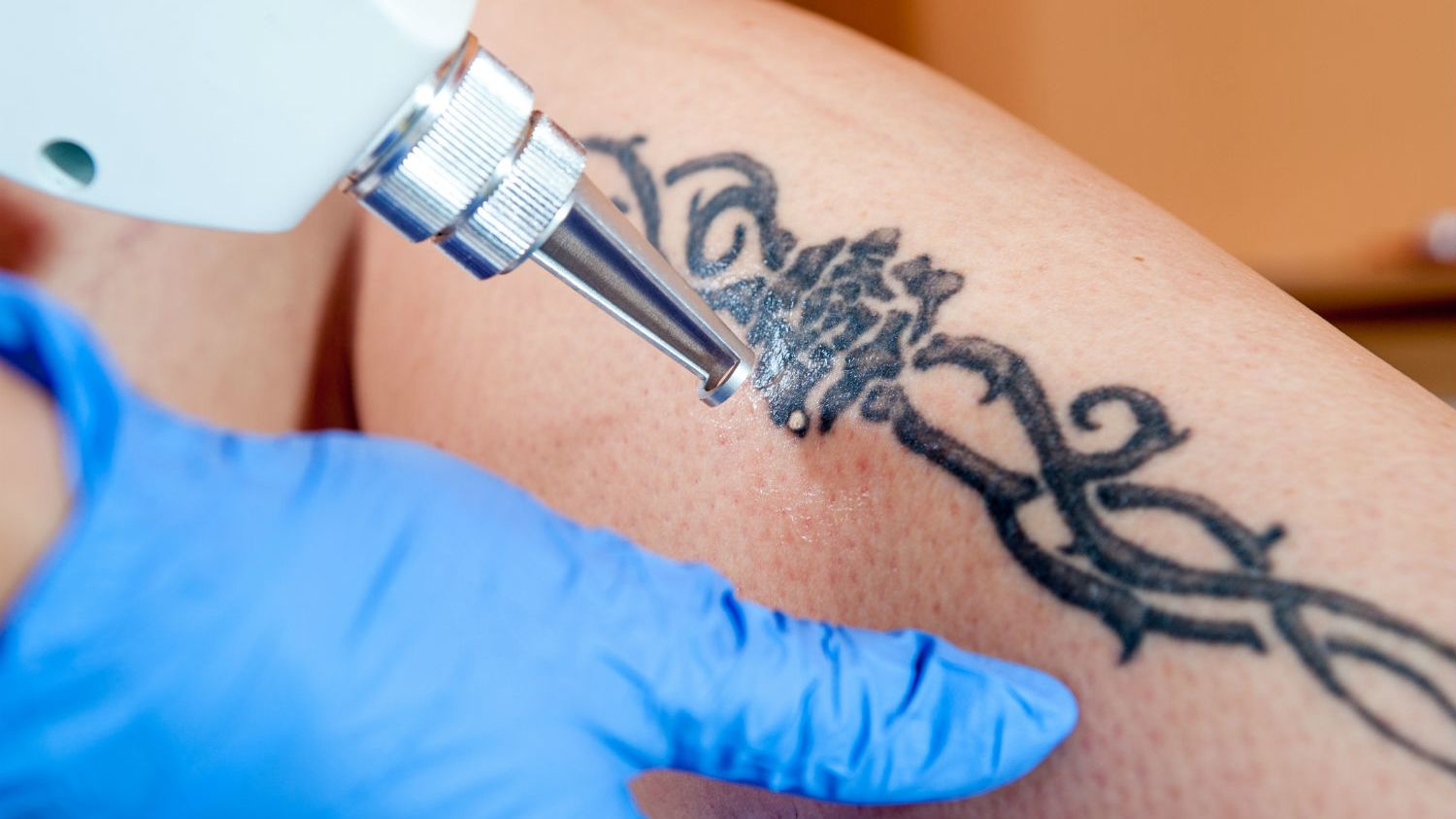 How Does Tattoo Removal Work Mental Floss How Does Tattoo