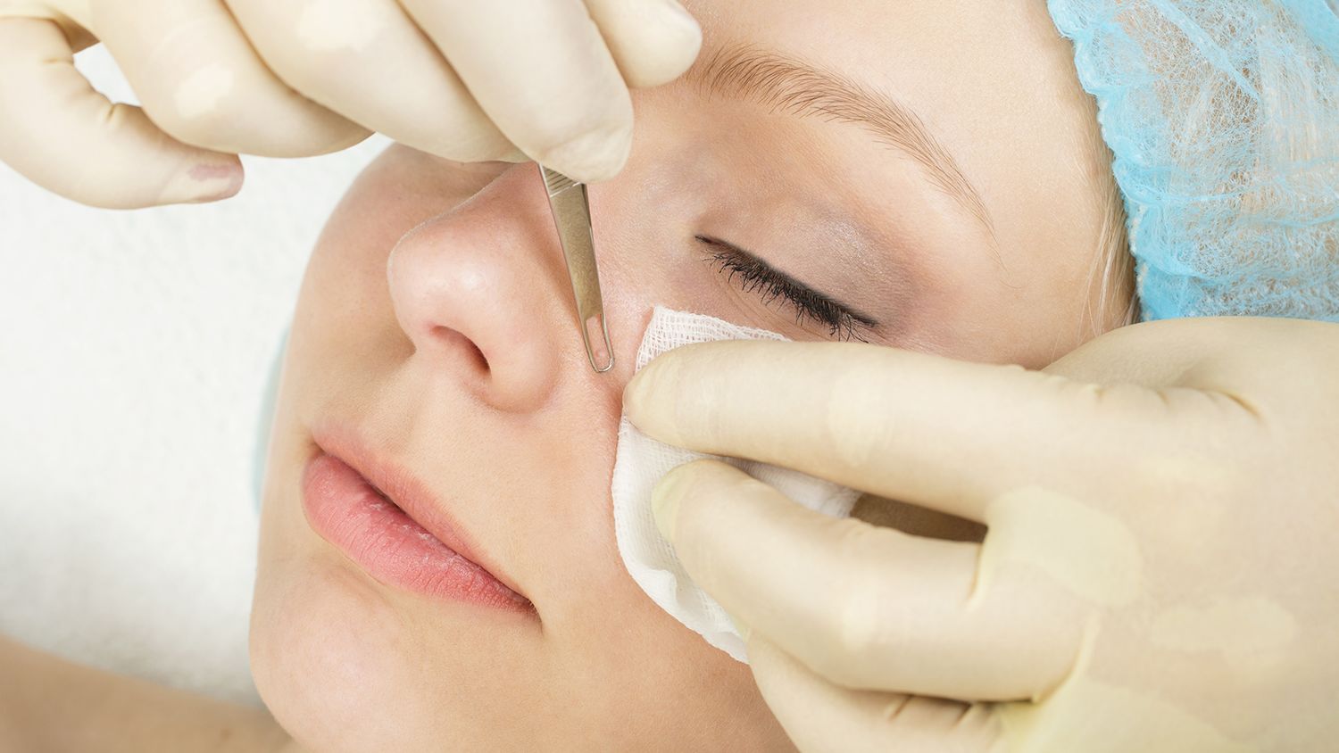 5 Facts About Blackheads from Dr. Pimple Popper Mental Floss