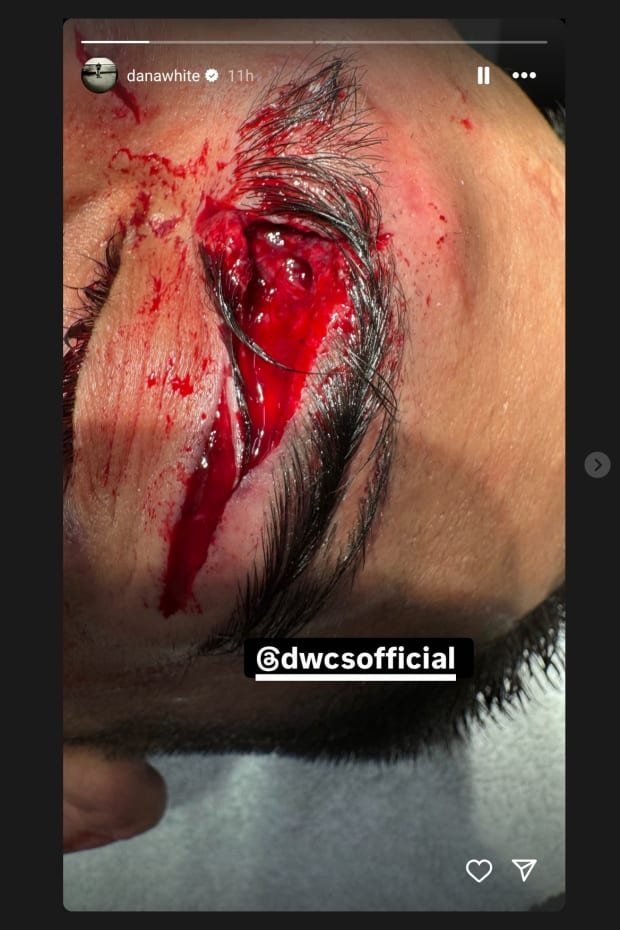 UFC CEO Dana White Shares Graphic Photos of Contender Series Injury