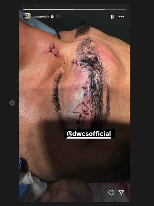 UFC CEO Dana White Shares Graphic Photos of Contender Series Injury