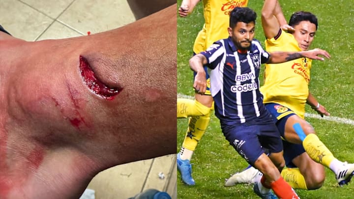 Tecatito Corona resultó con una herida tras la final de ida de la Liga MX Tecatito Corona resultó con una herida tras la final de ida de la Liga MX