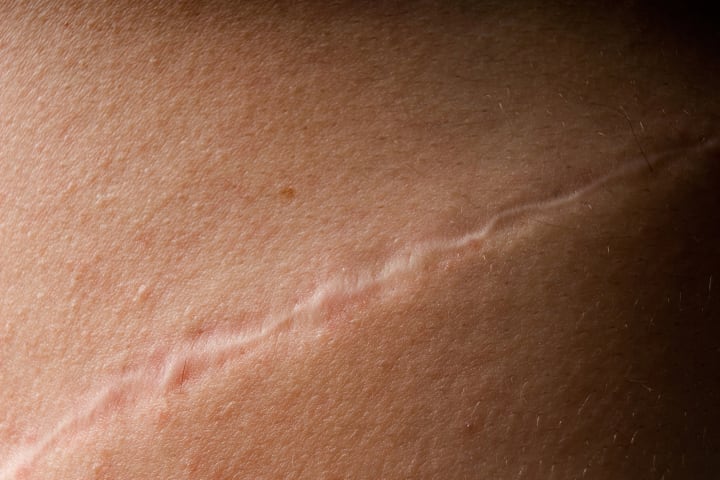 Close-up of a scar on a person's body