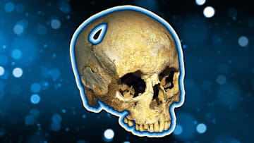 The 5500-year-old trepanned skull of a woman now displayed in a Swiss museum.