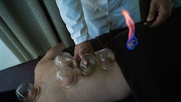 Undergoing Traditional Cupping Treatment In Hong Kong