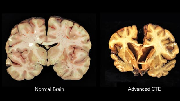 CTE in UFC & Power Slap