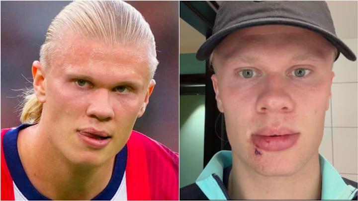 Haaland suffered a nasty facial injury on Norway’s team bus