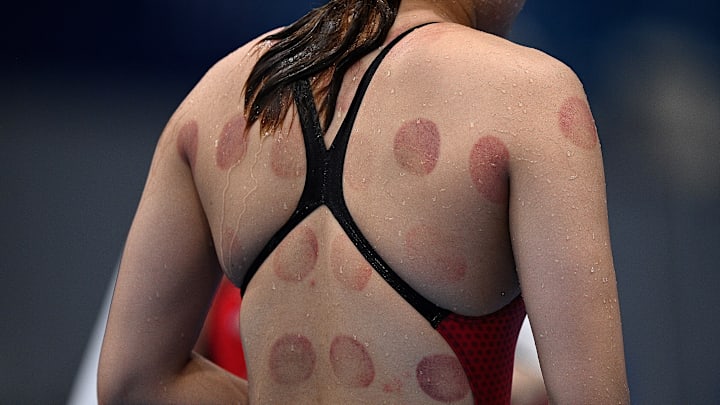 An Olympic swimmer sports circular bruises from cupping therapy.