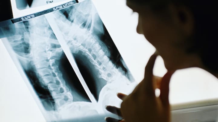 A doctor reviews a spine X-ray.