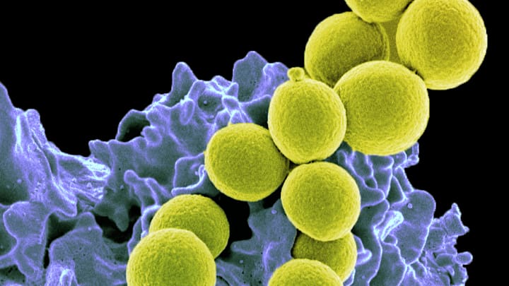 MRSA bacteria bound to a neutrophil, a type of infection-fighting white blood cell.