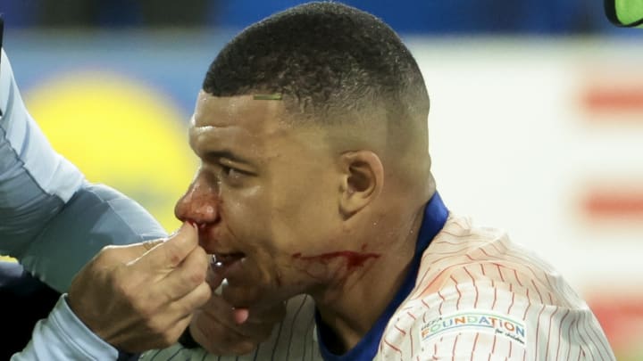 Kylian Mbappe hat sich die Nase gebrochen