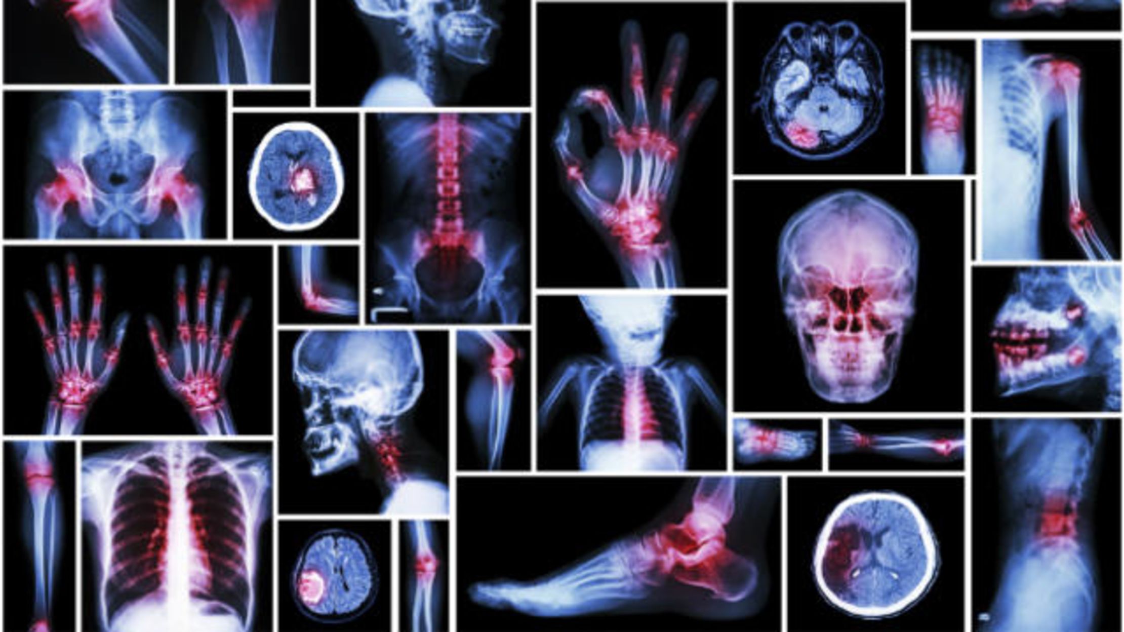 One Gene Mutation Links Three Mysterious Debilitating Diseases