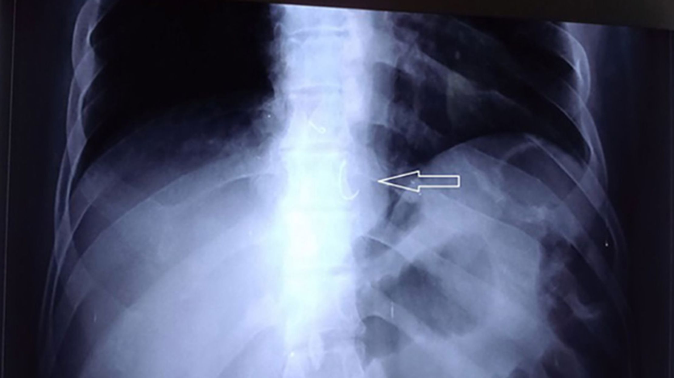 A Man Swallowed His Dentures and Didn’t Know for 7 Days Mental Floss