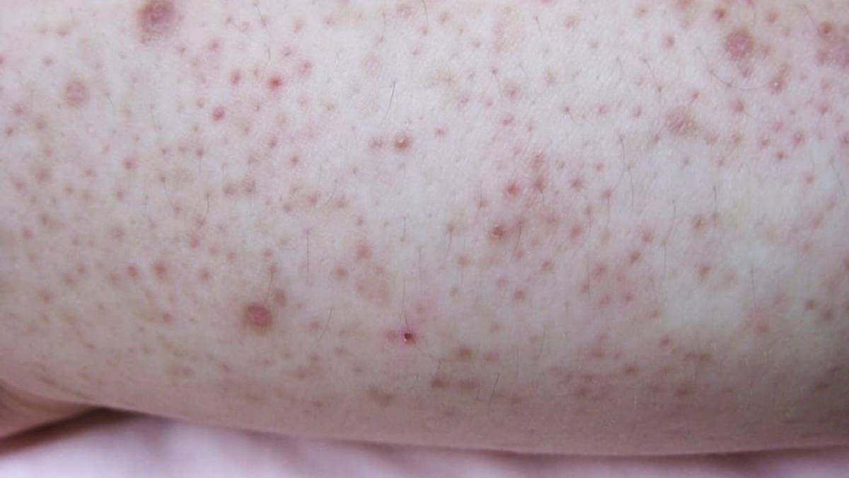 melanotan keratosis pilaris 10 Facts About From Dr. Pimple Popper Weigh Management