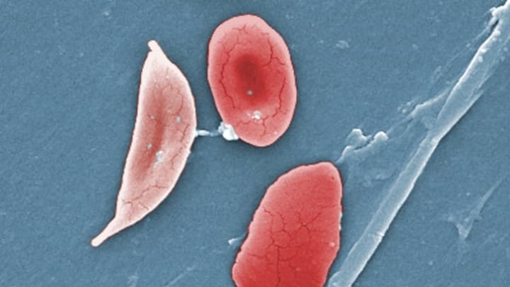 A digitally colorized scanning electron microscopic image showing the difference between a sickle cell red blood cell (left) and a normal red blood cell (right).