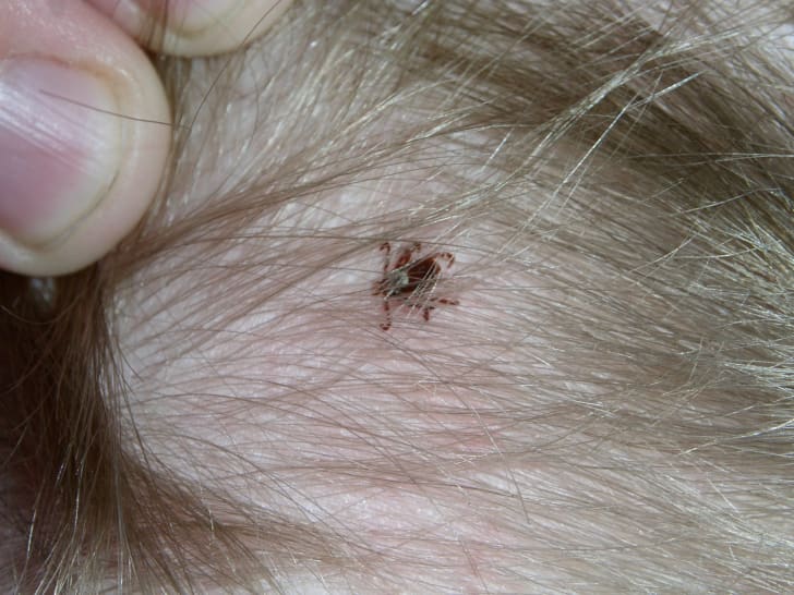 A tick hiding under human hair.