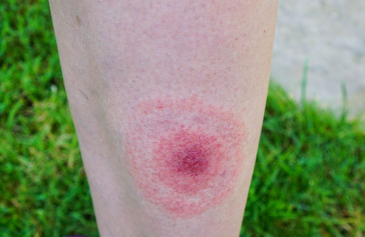 A bullseye rash from a tick bite.