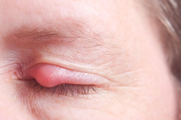 Close-up of an eye stye.