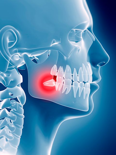 No one wants to deal with an impacted wisdom tooth.