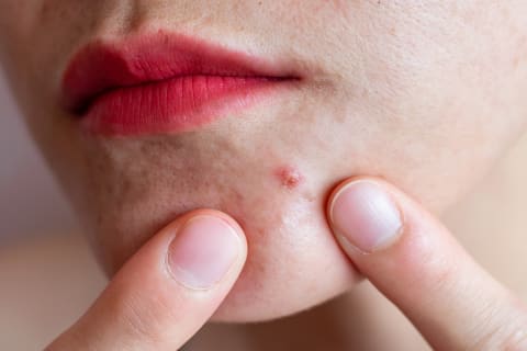 Unlike regular acne, maskne often appears on the cheeks and lower jawline.