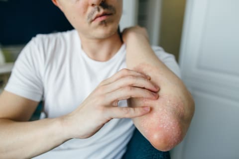 Atopic dermatitis is the most common type of eczema, but not the only form of it.