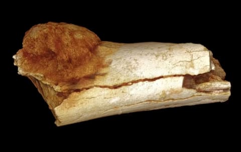 The world’s oldest known hominin cancer.