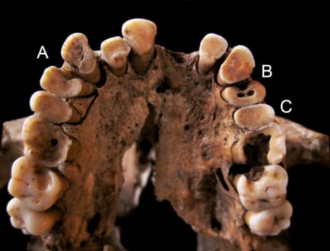 Some of the world’s oldest dental caries on the maxilla of specimen Taforalt XI C1: (A) contact caries, (B) attrition caries, and (C) gross caries.