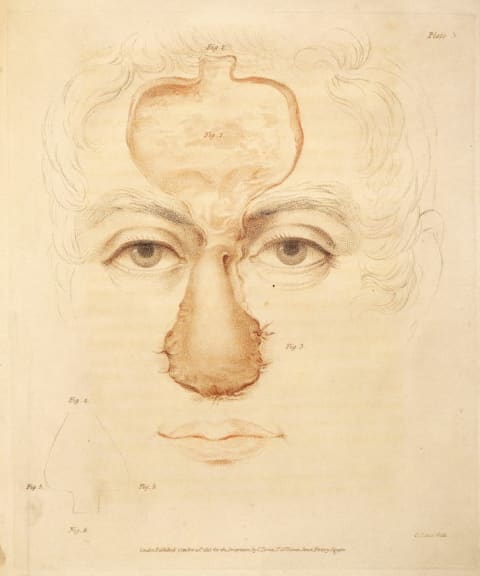 An image from J.C. Carpue's "An account of two successful operations for restoring a lost nose," 1816