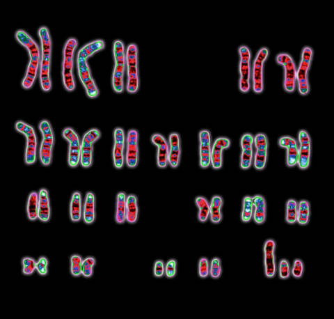 An XYY syndrome karyotype