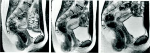 MRI images of a woman at rest, in a pre-orgasmic phase, and 20 minutes after orgasm (L–R)