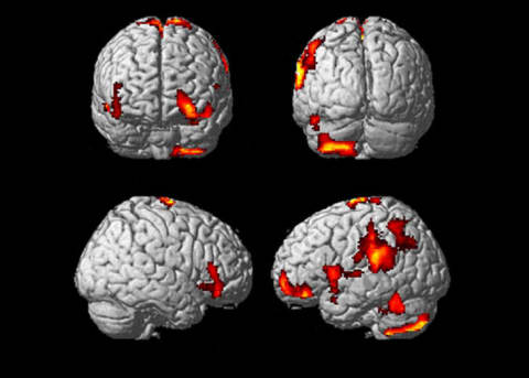 Activated portions of the brain during an out-of-body experience