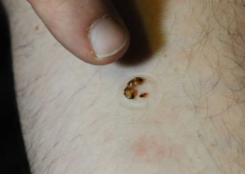 A man pointing to bed bugs feeding on his arm.