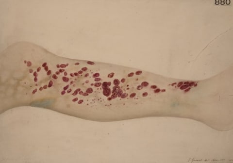 An 1887 sketch shows one of the symptoms—severe bruising—of scurvy.